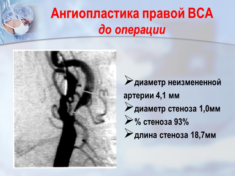 Ангиопластика правой ВСА до операции диаметр неизмененной артерии 4,1 мм диаметр стеноза 1,0мм %